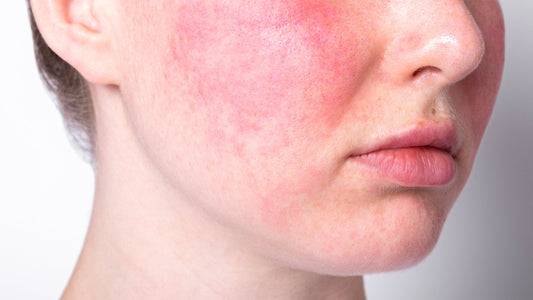 Rosacea